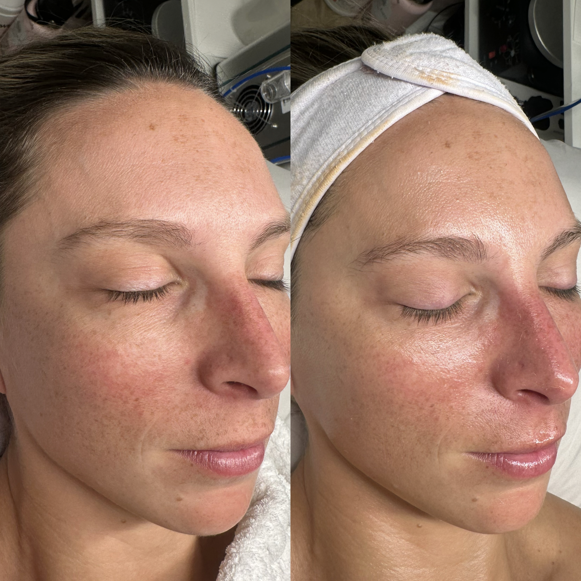 Facial before and after at Maison Kieu Beauté